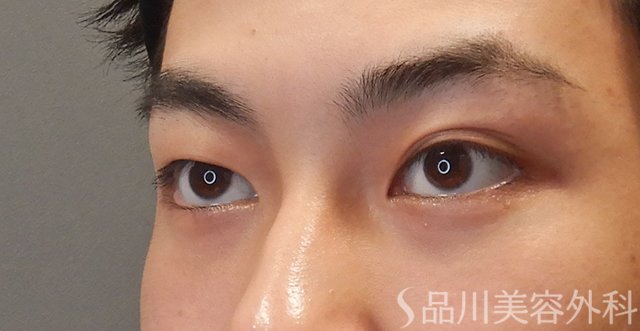 症例NO.74603のBEFORE写真
