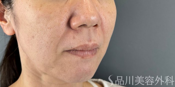 症例NO.71522のBEFORE写真