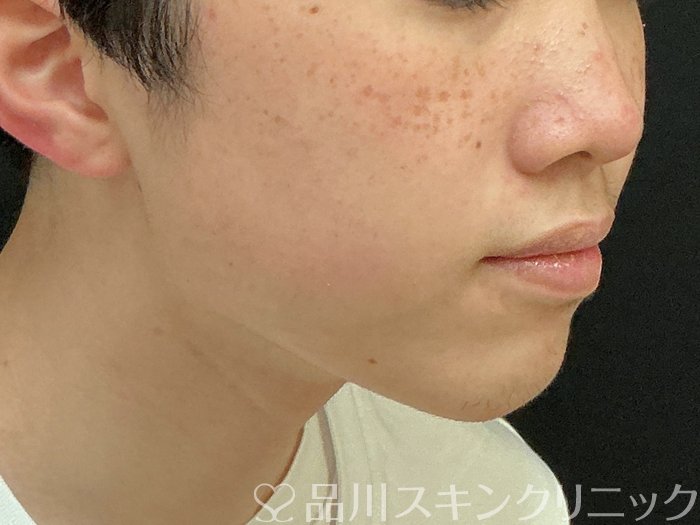 症例NO.73946のBEFORE写真
