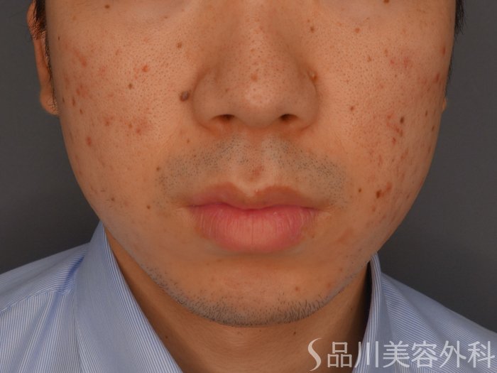 症例NO.73672のAFTER写真