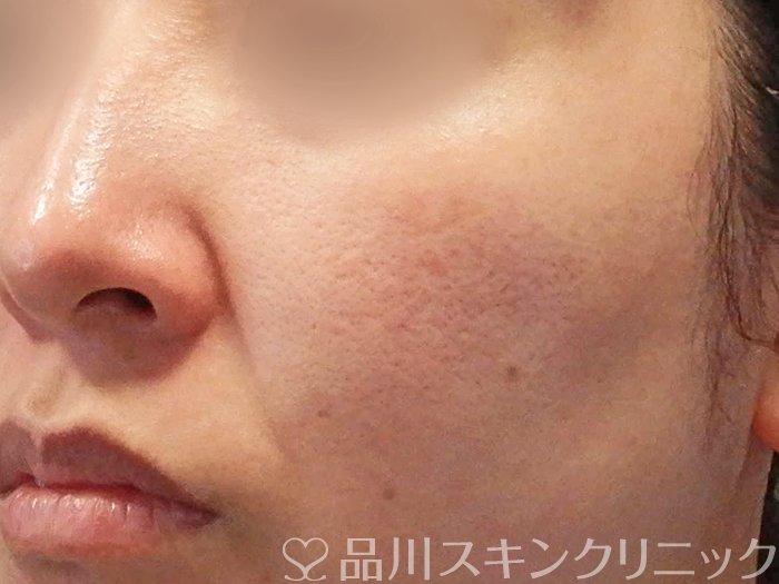 症例NO.65543のBEFORE写真