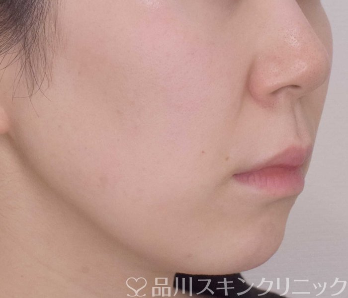 症例NO.69738のBEFORE写真