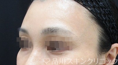 症例NO.66070のAFTER写真