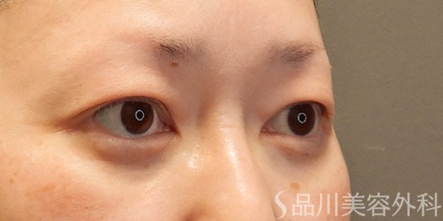 症例NO.74246のAFTER写真