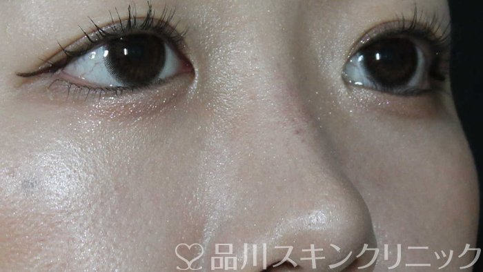 症例NO.71609のAFTER写真
