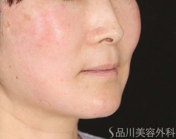 症例NO.72077のAFTER写真