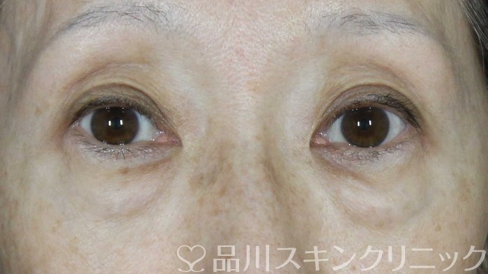 症例NO.72543のBEFORE写真