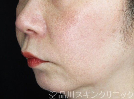 症例NO.64596のAFTER写真