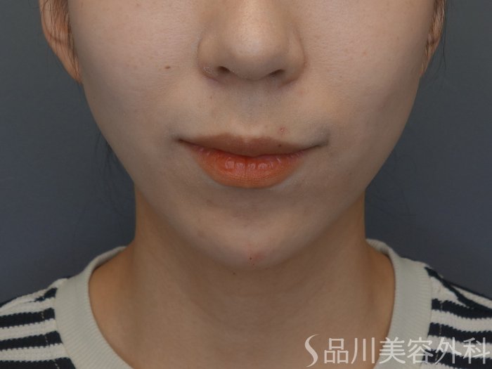 症例NO.74638のAFTER写真