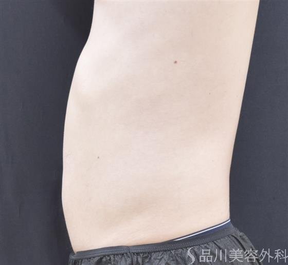 症例NO.44243のAFTER写真