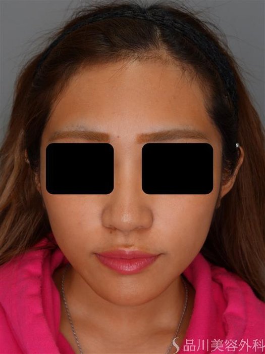 症例NO.52459のBEFORE写真