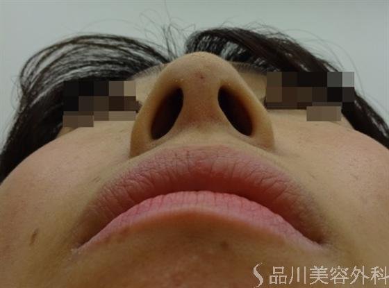症例NO.16426のAFTER写真