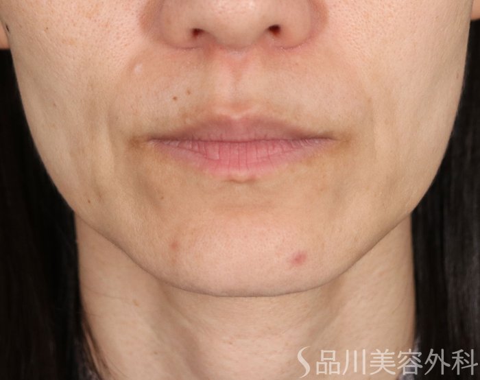 症例NO.72186のBEFORE写真