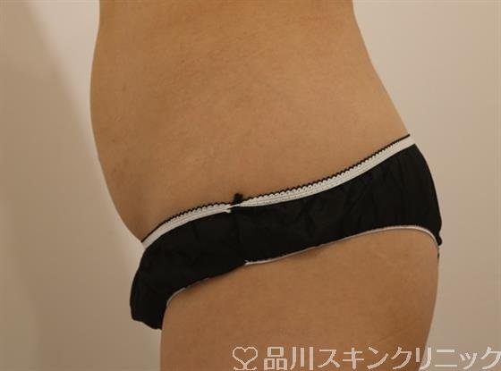 症例NO.44133のBEFORE写真