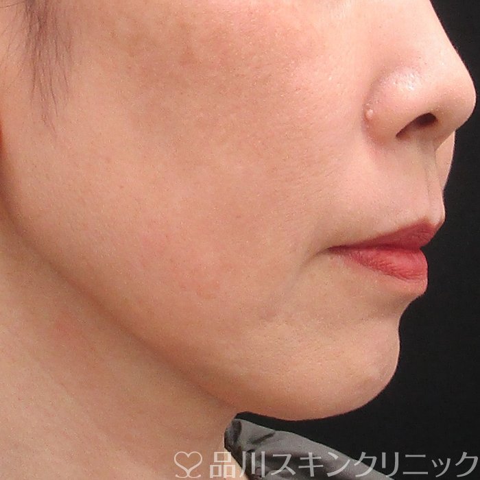 症例NO.74406のBEFORE写真