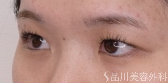症例NO.67311のBEFORE写真