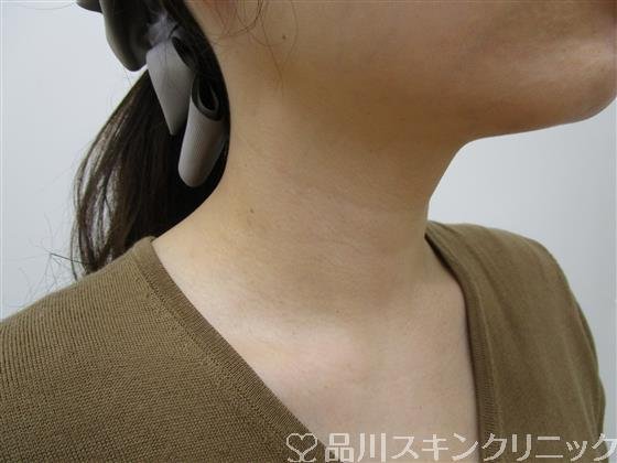 症例NO.39241のAFTER写真