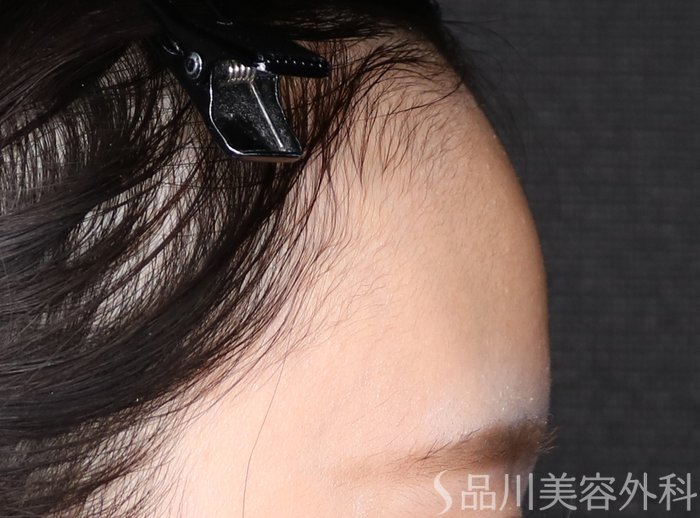 症例NO.71643のBEFORE写真