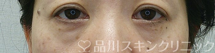 症例NO.69346のBEFORE写真