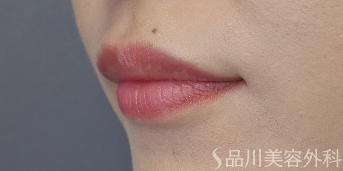 症例NO.71519のBEFORE写真