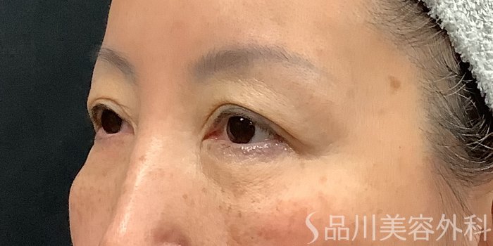 症例NO.73319のBEFORE写真