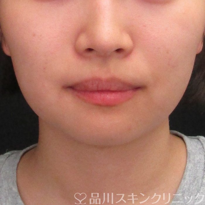 症例NO.73130のAFTER写真