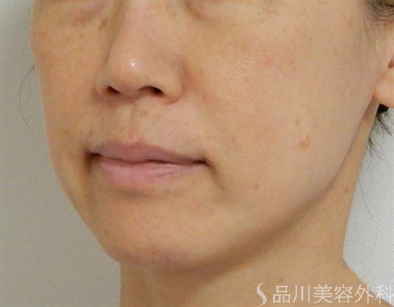 症例NO.38560のBEFORE写真