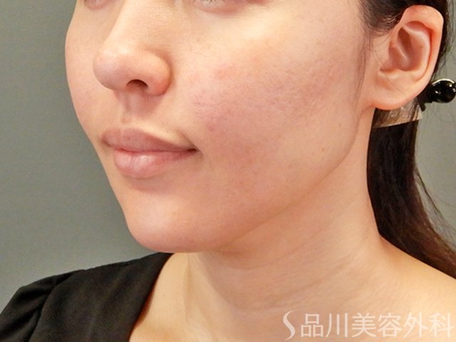 症例NO.64933のBEFORE写真