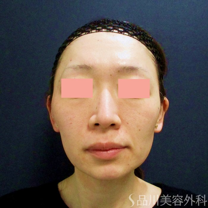 症例NO.70011のBEFORE写真