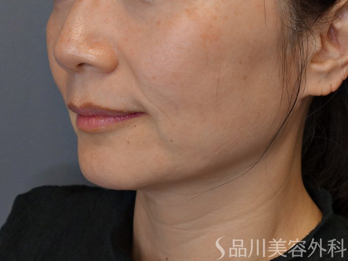 症例NO.74803のBEFORE写真