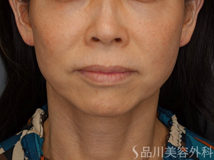 症例NO.74710のBEFORE写真