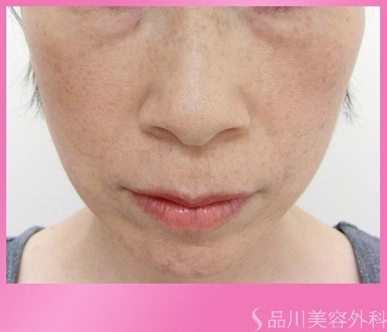 症例NO.1181のAFTER写真
