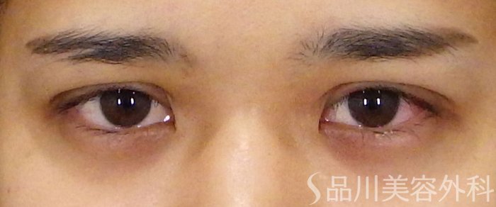 症例NO.71546のAFTER写真
