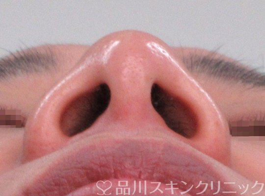 症例NO.71325のAFTER写真
