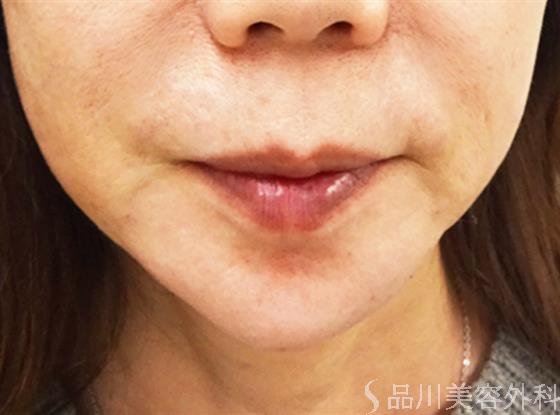 症例NO.32107のAFTER写真