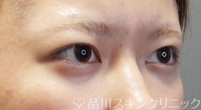 症例NO.67610のBEFORE写真