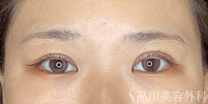 症例NO.64900のAFTER写真