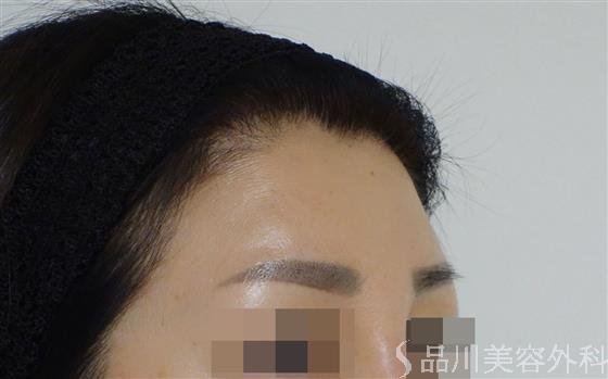 症例NO.49464のAFTER写真