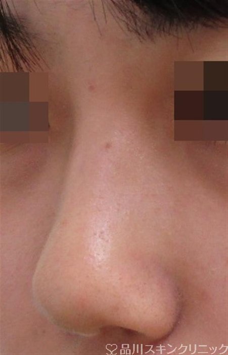 症例NO.30559のBEFORE写真