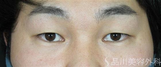 症例NO.58684のBEFORE写真