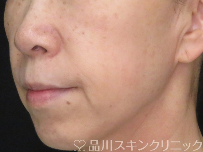 症例NO.70731のBEFORE写真