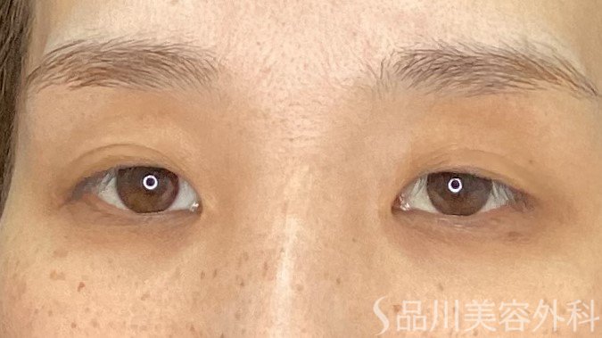 症例NO.71361のBEFORE写真
