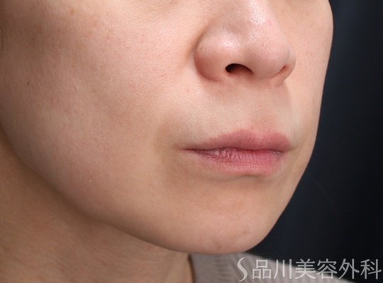 症例NO.69864のBEFORE写真