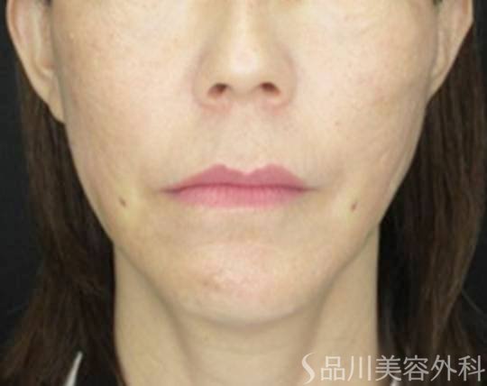 症例NO.72144のAFTER写真