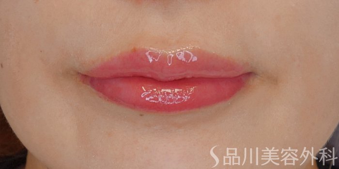 症例NO.72139のAFTER写真