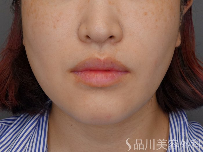 症例NO.70890のBEFORE写真