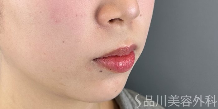 症例NO.72719のBEFORE写真