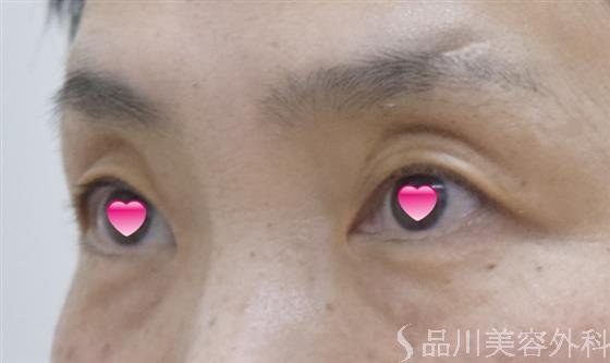 症例NO.54461のBEFORE写真