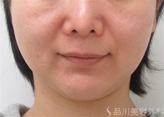 症例NO.31941のAFTER写真