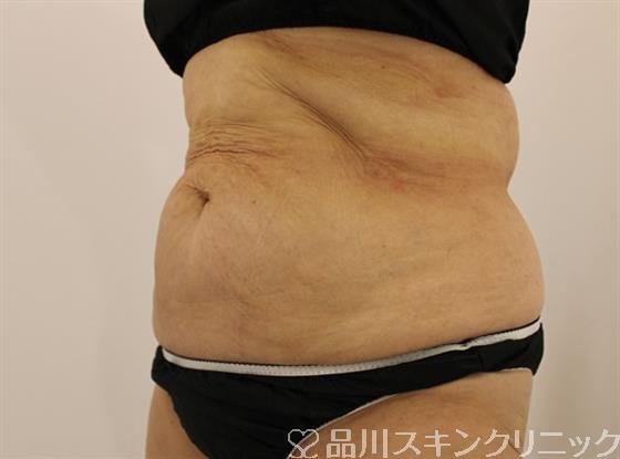 症例NO.46201のAFTER写真